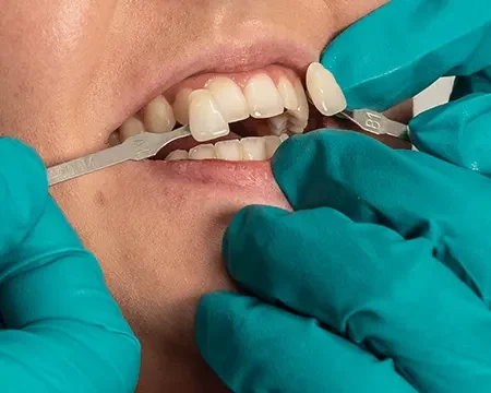 steinhaeuser-dentaltechnik-lexikon-f-facette